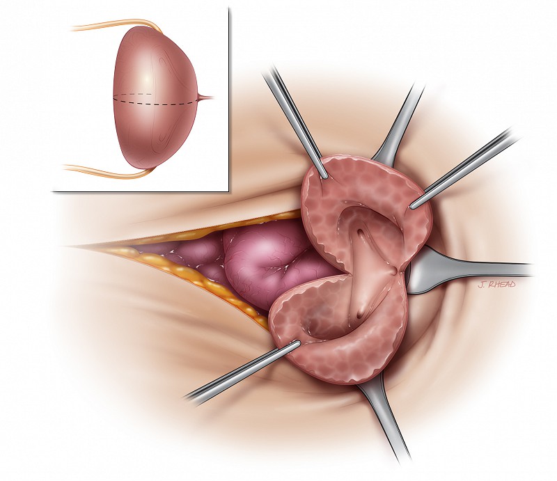 iliocecocystoplasty - clam shelled bladder