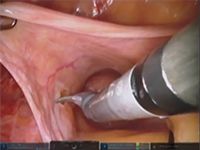 Bladder Neck Placement of Artificial Urinary Sphincter image thumbnail