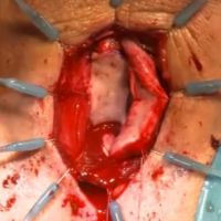 Bulbospongiosus Muscle Sparing Buccal Mucosa Urethroplasty video image