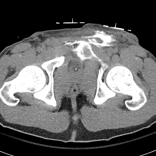 CT cystogram bladder neck injury 2