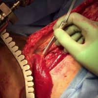 Gracilis Muscle Flap for Urologic Reconstruction thumbnail image