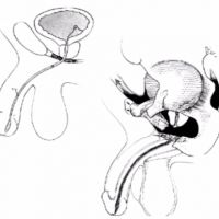 Pelvic Fracture Urethral Injuries image thumbnail