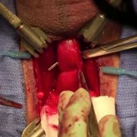 Posterior Urethroplasty for Pelvic Fracture Urethral Injury video image