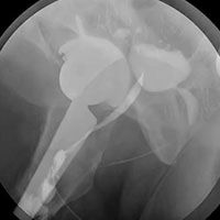 Posterior Urethroplasty with Gracilis Muscle Flap thumbnail image