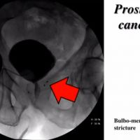 Radiation Injury & Prostate Cancer image thumbnail