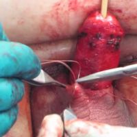 Treatment of Concealed Penis with Limited Panniculectomy and Genital Skin Graft image thumbnail