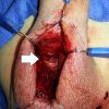 20 day old penile fracture med
