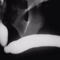 Anterior Urethral Strictures - Part 1 image