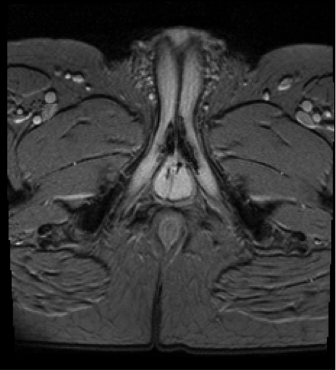 Arterio 1