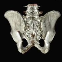 Endoscopic Urethral Realignment after PFUI image thumbnail