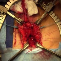 Prostate Cancer Radiation Treatment Related Urethral Strictures image thumbnail
