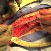 Staged Urethroplasty for Urethral Stricture from Failed Hypospadias Surgery video image
