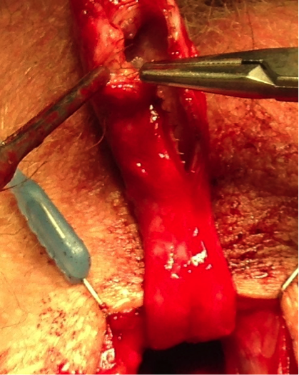 Stent 1