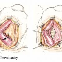 Urethral Strictures: Surgical Management Options image thumbnail